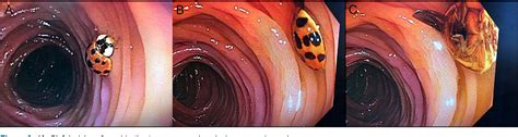 ladybug colonoscopy|Iba pa.